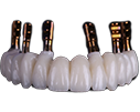 hybrid-dentures-new
